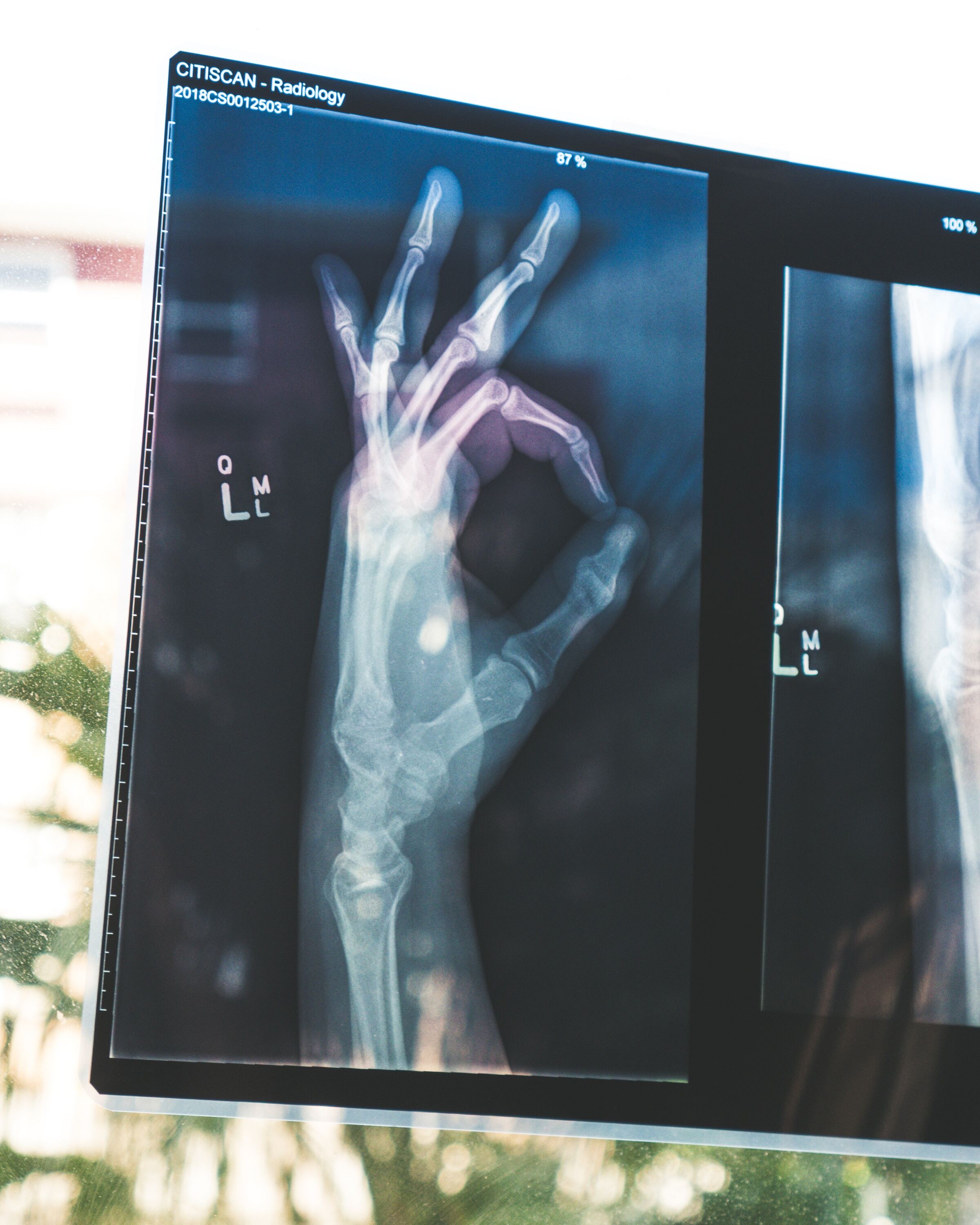 X-ray image of a hand making an OK gesture displayed on a screen.